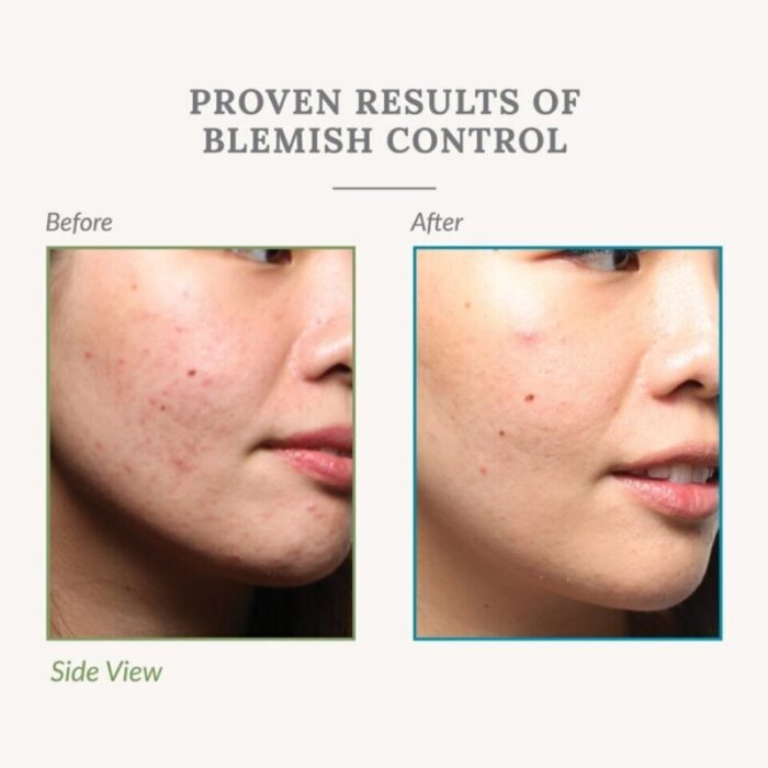 reerth blemish control 230801042932 3